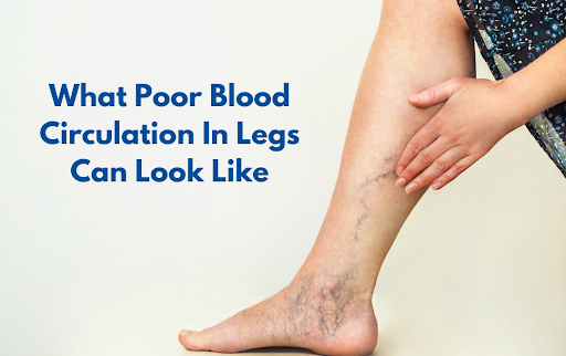 Causes Of Poor Blood Circulation In Legs | USA Vein Clinics